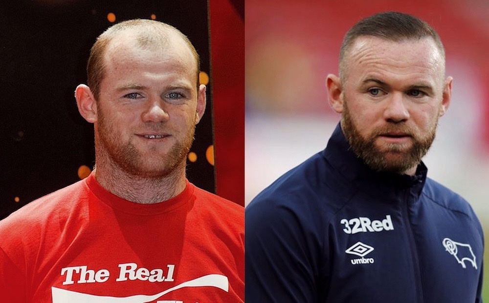 Wayne Rooney Hair Transplant — MedVoyage Medical Tourism